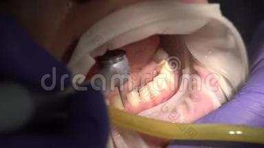 诊所牙科，安装贴面给病人在牙科诊所。 牙<strong>医美</strong>牙，微笑.. 关门